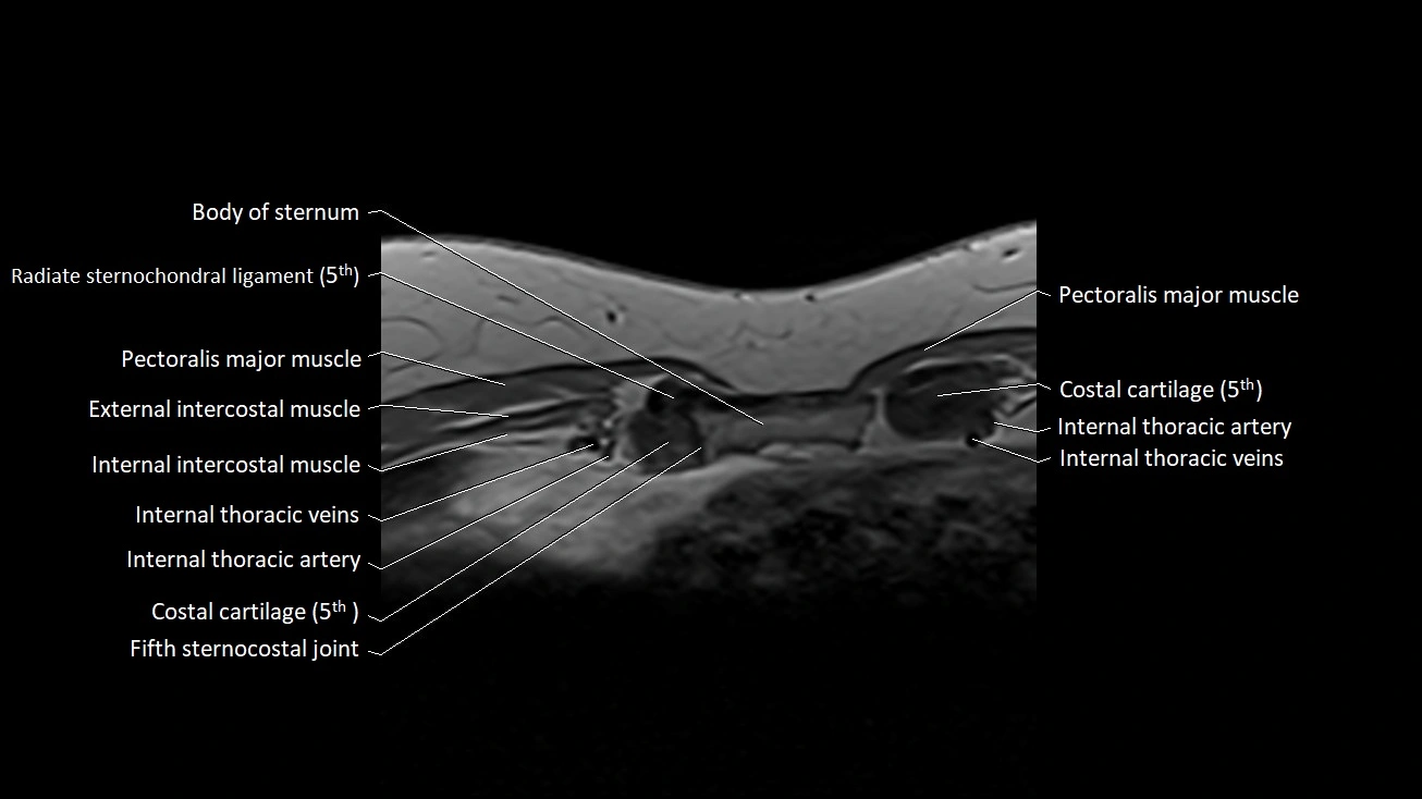 MRI sternum and sternoclavicular joint labeled axial anatomy image 29.webp
